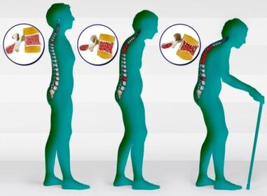 Osteoporoza